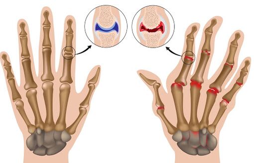 Arthritis und ihre Manifestation