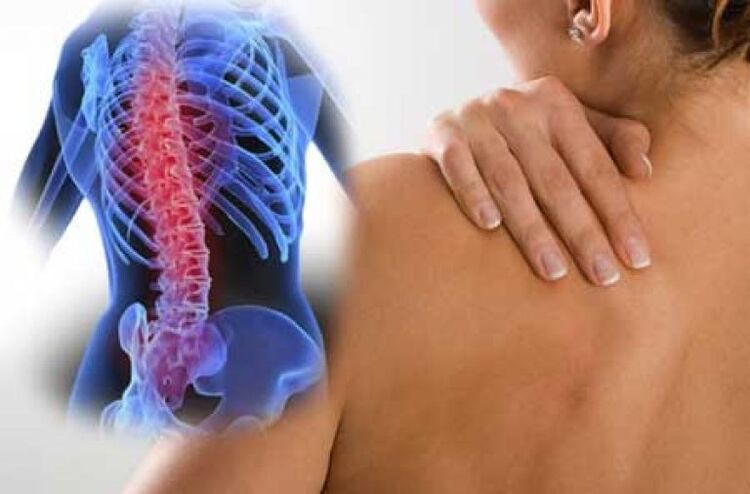 Bei einer Exazerbation einer Osteochondrose der Brustwirbelsäule treten Rückenschmerzen auf