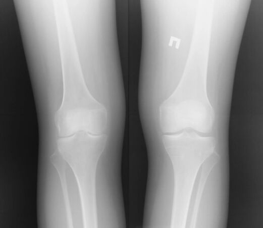 Die Radiographie des Kniegelenks