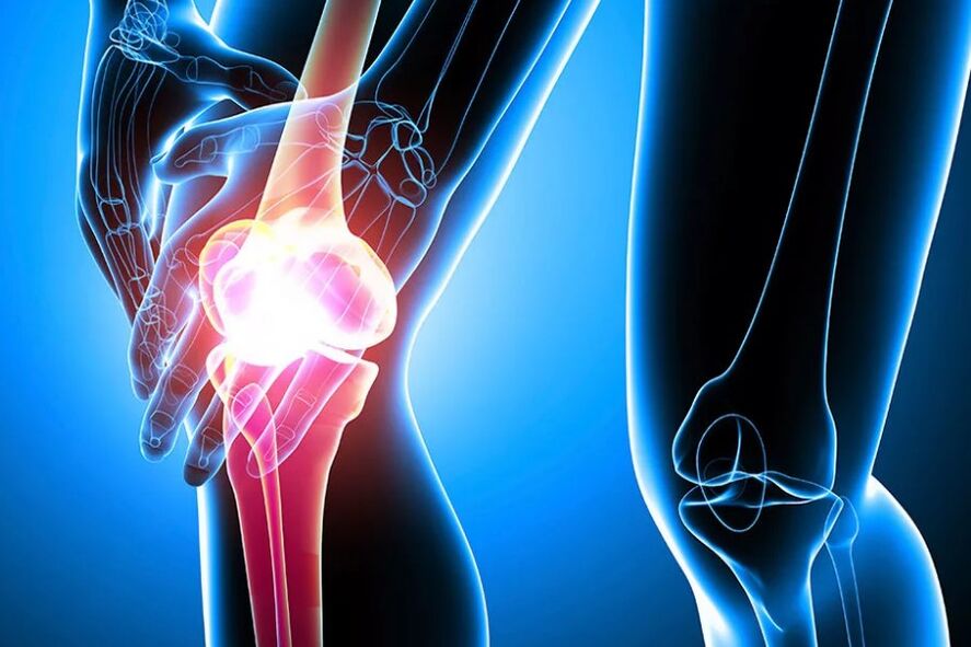 Osteoarthritis des Knies