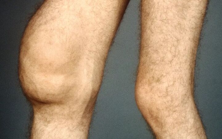 Post -Osteoarthritis -traumatisch des Kniegelenks