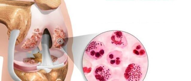 Dies führt zur Entwicklung einer Arthrose
