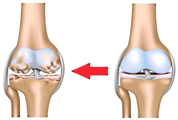 Gesunde und Arthrosis Gelenk