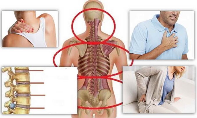 Krankheitsstellen für Osteochondose