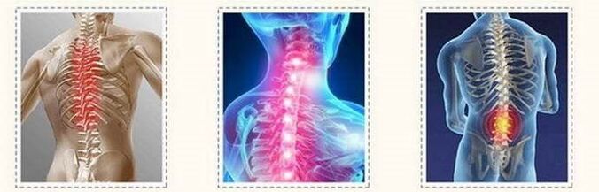 Wirbelsäulenverletzungen der Osteochondrose