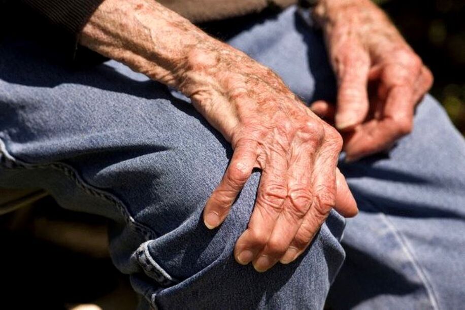 Arthrose ist eine altersbedingte Erkrankung, die ältere Menschen betrifft